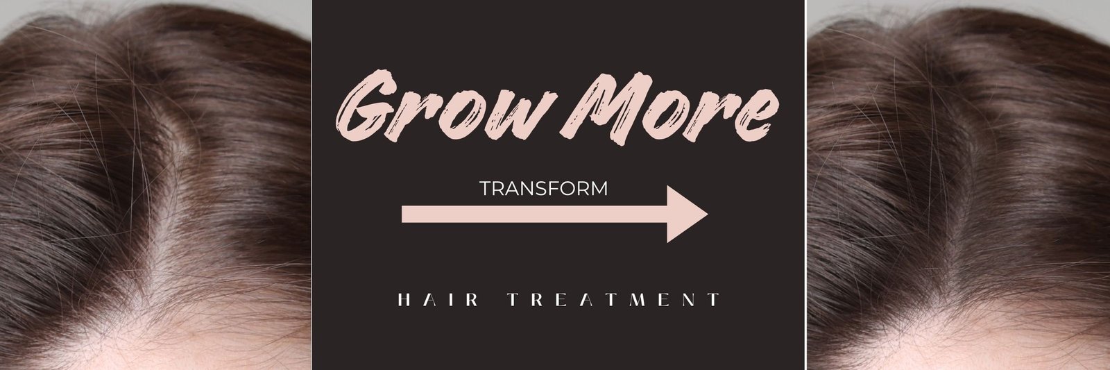 #BEST TREATMENT OF HAIR FALL, #BALDNESS,  #HAIR GROWTH, #ALOPECIA AREATA, #UNIVERSAL ALOPECIA